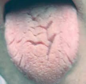 Dry Cracked Tongue