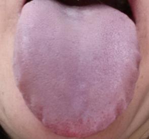 Purple Tongue