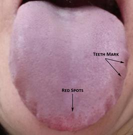 Tongue with Red Dard Spots