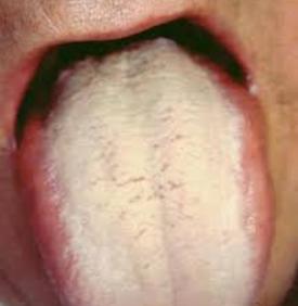 Tongue with Thick Coating